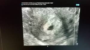 Despre dezvoltarea fatului, durerile si simptomele din sarcină, creșterea în. Embriotransfer SarcinÄ GemelarÄ OpritÄ In EvoluÈie DupÄ 5 SÄptÄmani De La Embriotransfer Youtube