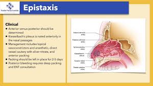 Image result for Epistaxis