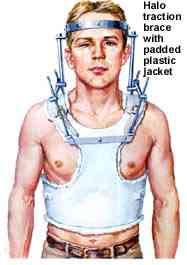 Cervical Spine Bracing Options Halo Ring Crowns Or Vest