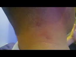 We did not find results for: I Found A Hard Lump On The Back Of My Neck Was It Cancer Youtube
