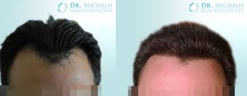 See more from patient 59989. Hair Transplant Of The Receding Hairline Hairforlife