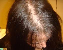 This causes temporary hair loss. Use Homeopathic Remedies To Treat Hair Loss Due To Anemia Vs Anorexia And Bulimia Vs Bug Bites And 14 More Visihow
