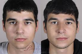 Male Rhinoplasty: George's Nose Job Experience & Unexpected Benefits  (Updated 2024)