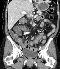 Image result for Neutropenic Colitis