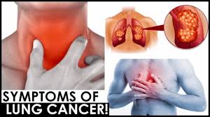 Because there are very few nerve endings in the lungs, a tumor could grow without causing pain or discomfort. 5 Sure Signs And Symptoms Of Lung Cancer Lung Cancer Symptons Signs Youtube