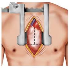 Download iate, european union, 2017. Sternotomie Chirurgie Cardiaque Clinique Saint Augustin Bordeaux