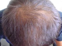 Lambdapil anticaída cápsulas aporta nutrientes que actúan de forma combinada para mantener el cabello en las mejores condiciones de anclaje, fuerza y crecimiento: Lambdapil Anti Hair Loss Complete Solution For Alopecia Isdin
