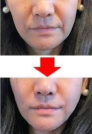 やっと ブルドック顔 とおさらばできるコスメが発売 もうほうれい線で悩まない ramona ヘルスフィットネス 顔のエクササイズ ほうれい線