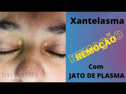 Image result for xantelasma