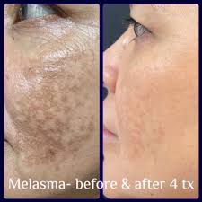 Image result for Melasma
