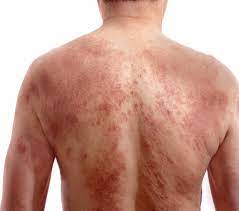 5 Tips For Preventing An Eczema Flare-Up: Manhattan Dermatology: General,  Surgical, & Cosmetic Dermatology