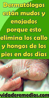 Dermatologos Estan Mudos Y Enojados Porque Esto Elimina Los Callo Y Hongos De Los Pies En Dos Dias Dermatologo Remedios Para La Salud Remedios Pies Agrietados