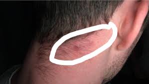 Wiederkehrende feste Beulen am HinterkopfHals und geschwollene Lymphknoten  hinter dem Ohr. Staphylokokken? : rFolliculitis