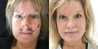 Given time to grow, treatment for skin cancer becomes more difficult. How To Prevent Skin Cancer Woman Has 40 Spots Removed Over 25 Years After Tanning