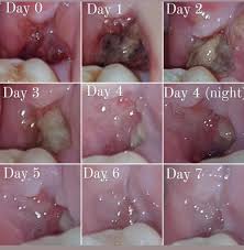 Image result for Tooth Extraction