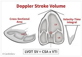 The first tab in the stroke volume calculator employs cardiac output calculations and registered heart rate while the second tab uses the results from the doppler vti method. Aortic Stenosis Breaking Down The Continuity Equation