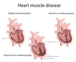 Image result for Restrictive Cardiomyopathy