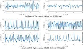 What does shockable rhythm mean? Examples Of Misclassified 8 S Ecg Samples From The Public Left And Download Scientific Diagram
