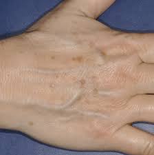 Dabei wird die haut zwei bis drei wochen morgens und abends mit einer speziellen fruchtsäurehaltigen reinigungslösung gesäubert. Hautarztpraxis Dr Hempel Altersflecken Laserentfernung