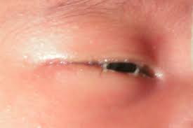 Rambut alami maupun sintesis/bulu mata palsu. Kerap Berair Bertahi Mata 5 Perkara Mama Papa Perlu Tahu Tentang Blocked Tear Duct