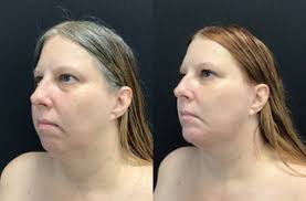 Cirugía Plástica Facial Antes y Después