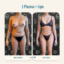 Image result for Liposuction