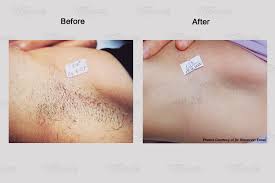 The skin may also appear red in colour and the area around the follicle itself may become raised. Brazilian Laser Hair Removal