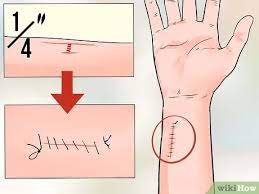 Thus, it is important to see not only how large the wound is, but also how deep it has reached into the deeper layers of the skin. How To Determine If A Cut Needs Stitches 9 Steps With Pictures