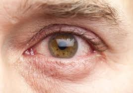 Bloodshot eyes are eyes with noticeable blood pigments and swollen blood vessels. Bloodshot Eyes It Could Be Hypertension Premier Internal Medicine Associates Internal Medicine Specialists
