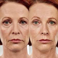 Pin On Botox And Facial Fillers