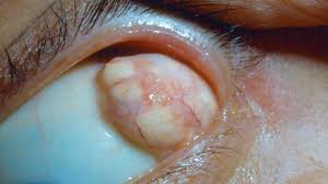 We did not find results for: Dermoid Cyst Types Pictures Symptoms Treatment Surgery