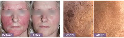 I've never done brazilian ipl before so i can't gauge if it's more or less painful. Lifescape Aesthetics New Ellipse Ipl Photofacial