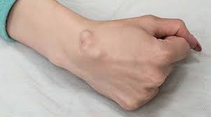 Penyakit angina merupakan kondisi dimana adanya penyempitan di dalam pembuluh darah arteri yang menyebabkan suplai darah ke selain penyakit serangan jantung dan angina, nyeri dada juga sangat mungkin terjadi karena adanya diseksi aorta. Penyakit Fibroadenoma Gejala Penyebab Dan Cara Mengobati Halodoc Com