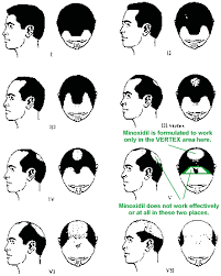 Normal Hair Growth Pattern Hair Loss Male Female Dht Hair