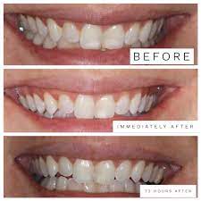 Once your teeth start receiving contact with saliva, these morning white spots typically fade away during the day. Sunshine Smiles Of Orange County Blog How To Get Rid Of White Spots On Your Front Teeth Easily And Pain Free