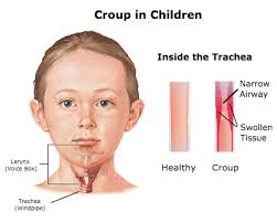 Whooping cough, also known as pertussis, is an extremely contagious disease caused by the bacterium bordetella pertussis. Croup Vs Whooping Cough Difference Between