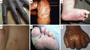 Image result for scabies on genitals