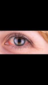 Whenever You Wake Up From A Night Of Sleep Are Your Eyes Bloodshot It S Because Your Eyes Stop Making Tears During Sleep Dry Eye Syndrome Dry Eyes Allergan