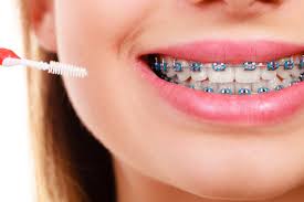 You can't remove invisalign attachments or buttons at home, because it can damage your teeth and make the situation worse. 6 Tools For Cleaning Braces Chelian Orthodontics