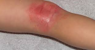 Image result for Contact Dermatitis