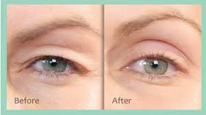 How does botox eyebrow lift work? Eyebrow Lift Treatments In Edmonton Albany Laser