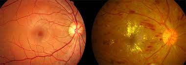Diyabetik Retinopati