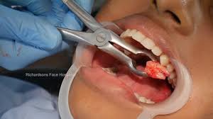 What kind of doctor removes wisdom teeth. Surgical Wisdom Tooth Extraction By Specialist Surgeon Dr Sunil Richardson Youtube