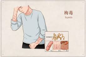 Image result for Syphilis