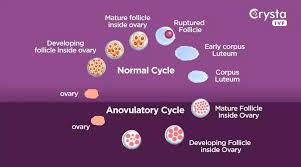 Image result for Anovulation