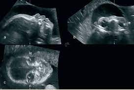 Ultrasound 25 week fetus pictures. Three Orthogonal Plane Display Of A Fetus In Breech Presentation At 25 Download Scientific Diagram