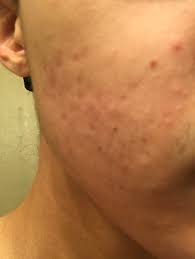 Emuaid.com has been visited by 100k+ users in the past month Skin Concern What Can I Use To Get Rid Of Acne Scars Like These Skincareaddiction