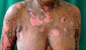 Image result for Pemphigoid