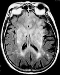 Infezioni virali alcuni virus sono responsabili negli animali e nell'uomo di patologie. Convivere Con La Sclerosi Multipla