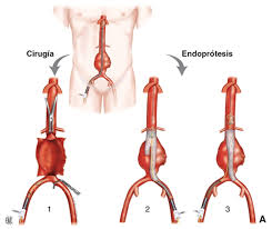 Encuentra los mejores especialistas en aneurisma aórtico abdominal en méxico y resuelve tus dudas preguntando a los expertos. Rupturas De Aneurisma De La Aorta Abdominal Tecnicas Especificas Sciencedirect